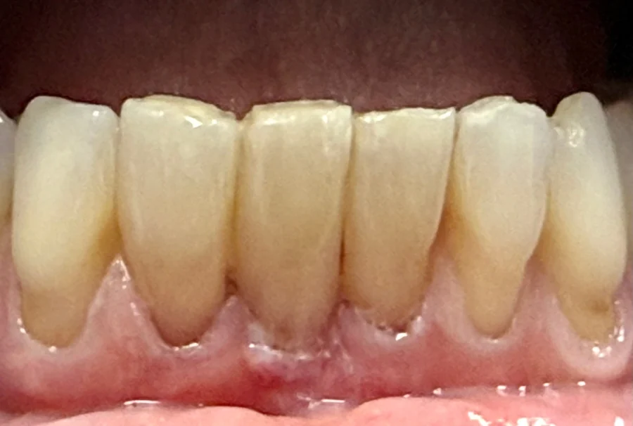 After: the same lower front teeth, even and the gap closed.