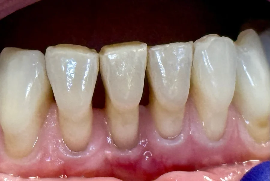 Before: worn, uneven lower front teeth with a gap.