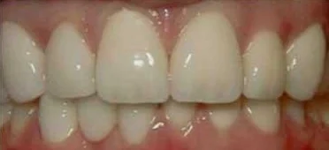 After: the gap filled by an implant crown that matches its neighbours.