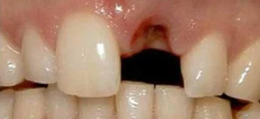 Before: a missing upper front tooth.