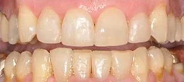 After: the same teeth reshaped and straightened with bonding.
