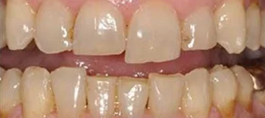 Before: stained, uneven front teeth.