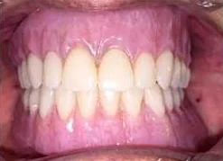After: the finished upper denture in place.