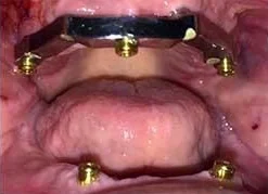 Before: the implants and bar that will hold the upper denture.